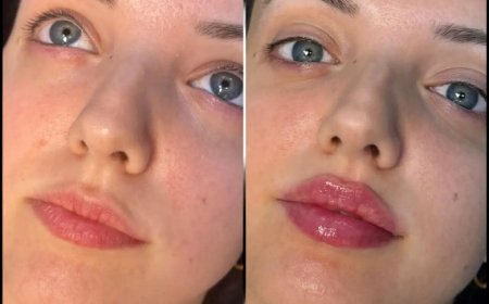 The Best Doctors in dubai for Fillers: Experience and Precision