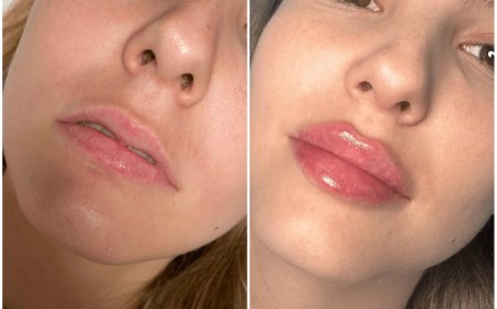 Juvederm Treatment in Dubai for Correcting Scarring