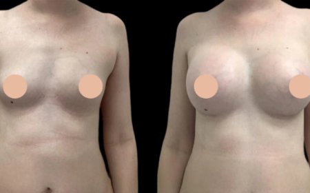 Dubai’s Best for Breast Augmentation Surgery