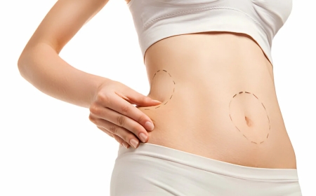 Discover the Best Fat Transfer Surgeons in Dubai for Facial and Body Contouring