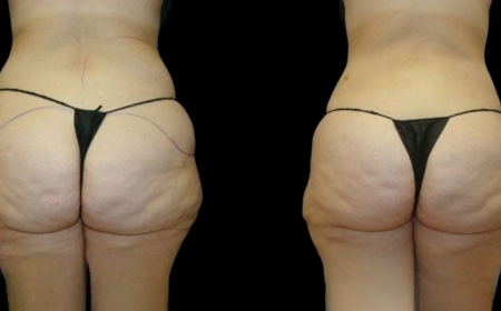 The Best Butt Fat Transfer Surgeons in Dubai for a Natural-Looking, Sculpted Silhouette
