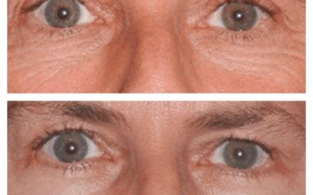 How Long Does It Take to Heal? Answers from the Best Eye Bag Removal Surgeon in Dubai