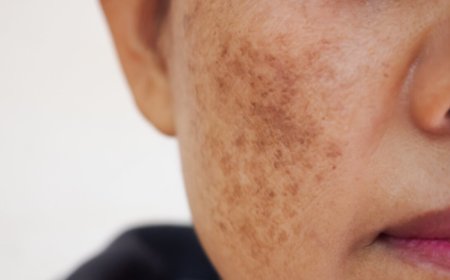 How Effective Are Laser Treatments for Melasma in Islamabad?