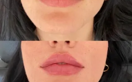 Natürliche Ergebnisse mit Lippeninjektionen – geht das wirklich?