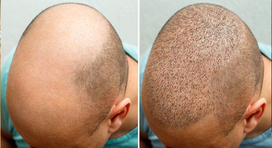 Affordable Hair Transplant in Dubai: Top Picks