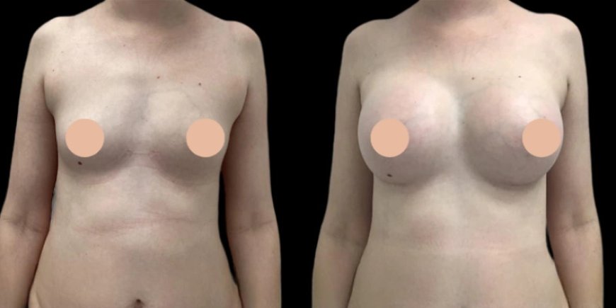 Dubai’s Best for Breast Augmentation Surgery
