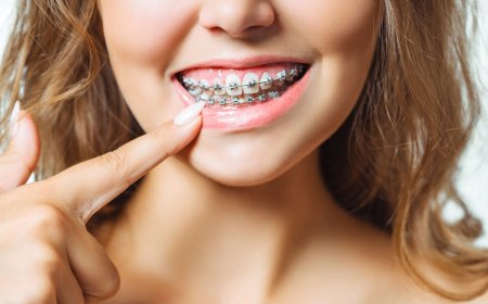 Step-by-Step Guide to Getting Braces in Islamabad