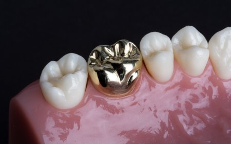 Difference Between Dental Crowns and Bridges: Explained Simply