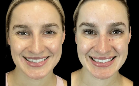 Best Aesthetic Clinic in dubai Shares Botox Aftercare Tips You Must Know