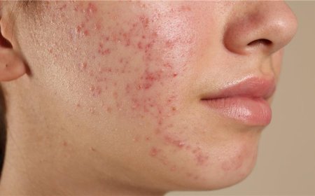 What Is the Best Acne Treatment for Teenagers in Abu Dhabi?