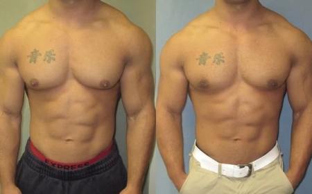 A Complete Guide to Gynecomastia Treatment in Islamabad