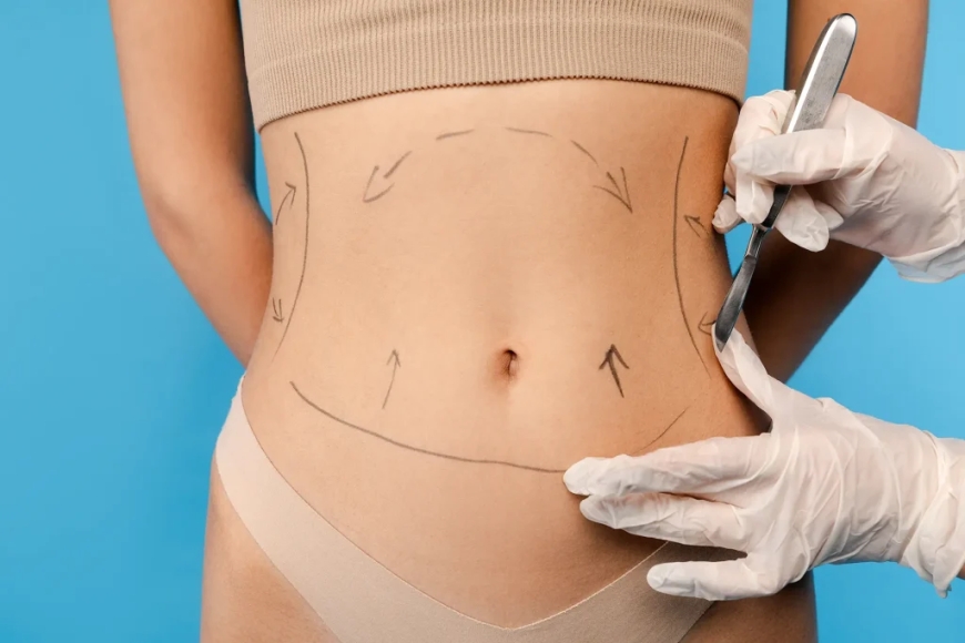 Benefits of Choosing a Mini Tummy Tuck in Dubai Over Full Surgery